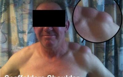 Scaffolders Shoulder – the bodies compensation for increased stress on the shoulder
