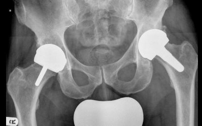10 ways to make your hip replacements last longer.