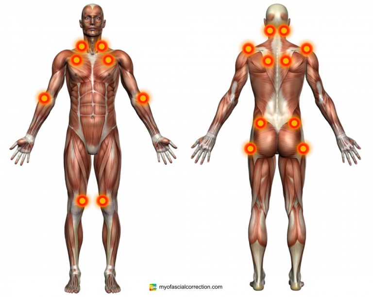 Fibromyalgia Tender Points Plymouth Chiropractor