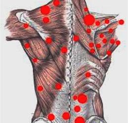 What are Trigger points?