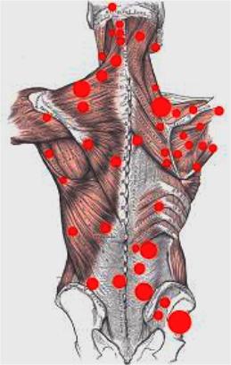 What are Trigger points?